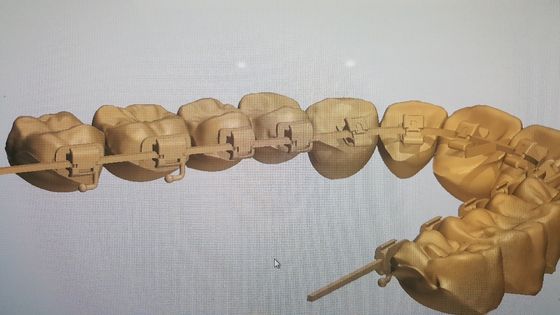 Puissante source de machines DTC Orthodontie Braces de langue avec braquettes auto-ligantes
