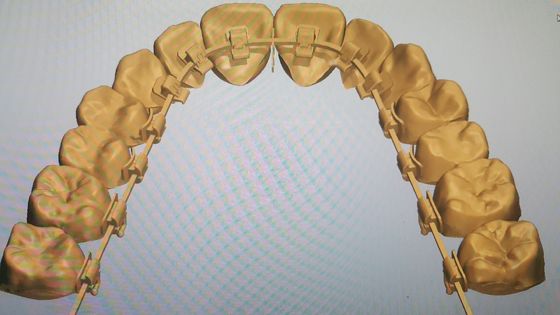 Puissante source de machines DTC Orthodontie Braces de langue avec braquettes auto-ligantes